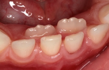 έκτοπη ανατολή μονίμου, δύο σειρές δόντια, στραβά μόνιμα δόντια, εξαγωγή νεογιλού, μόνικαι και νεογιλά δόνιτα μαζί, Τσαλιγοπούλου Ευθυμία, Λαγκαδά 130, Τηλέφωνο 2310 822572, οδοντίατρος, οδοντιατρικές υπηρεσίες, δόντια, υγεία στόματος, οδοντιατρική υγεία, οδοντιατρείο, odontiatros, odontiatrikes upiresies, dontia, odontiatreio, odontiatriki ygeia, ygeia stomatos